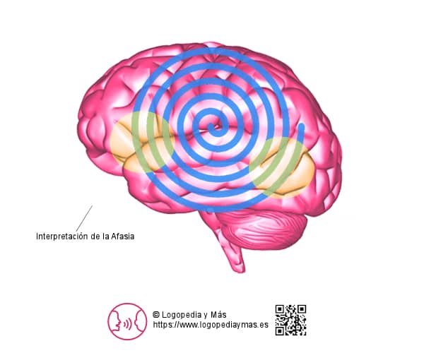 tratamiento de la afasia