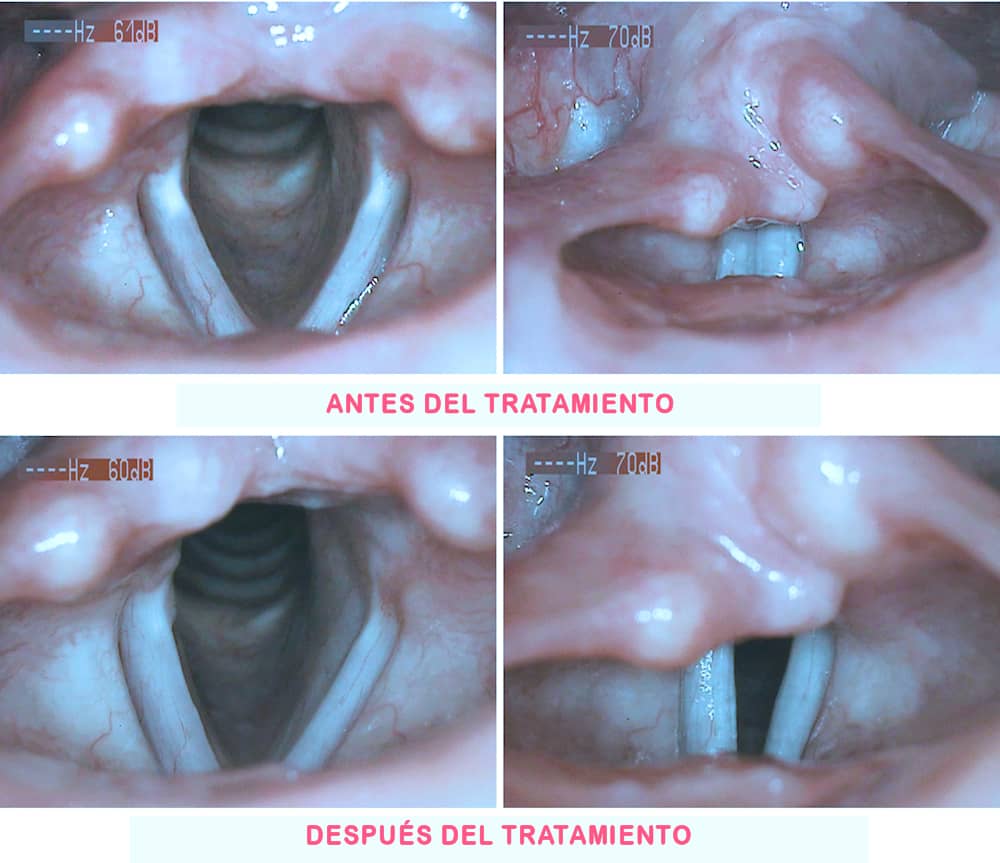 cuales son los tipos de disfonia