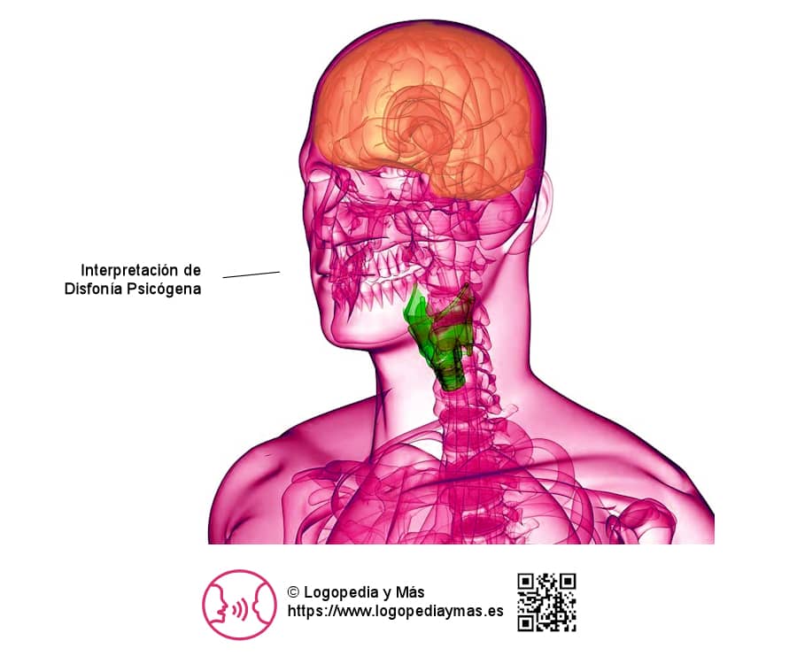 disfonia psicogena