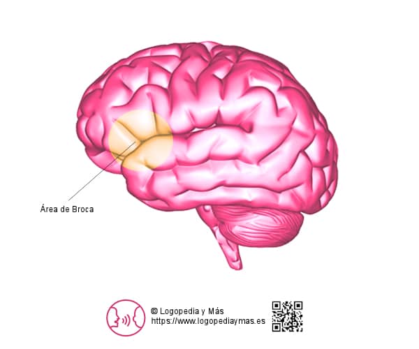 la afasia de broca