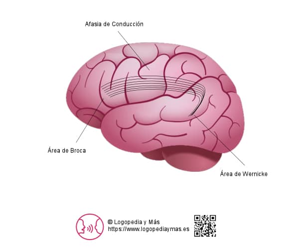 la afasia de conducción