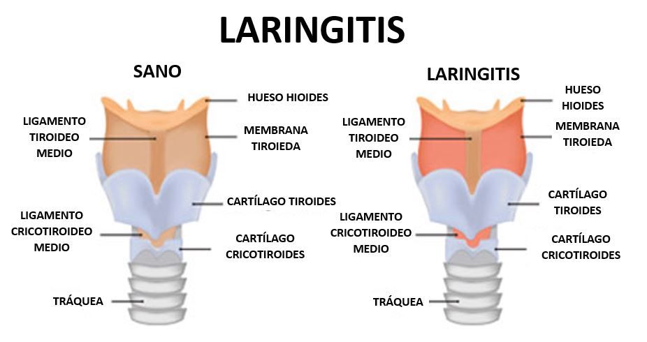 laringitis en niños