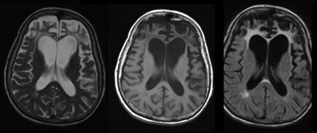 demencia frontotemporal hereditaria