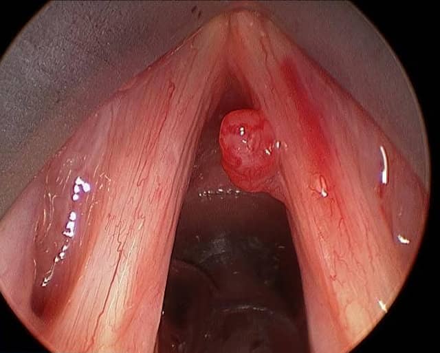 polipos en las cuerdas vocales