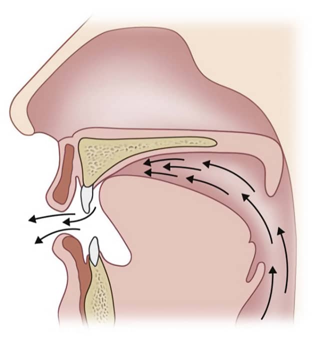 rinolalia tratamiento