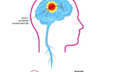 ¿Qué es un Ictus?