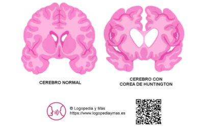 Enfermedad de Huntington. Síntomas y Esperanza de Vida