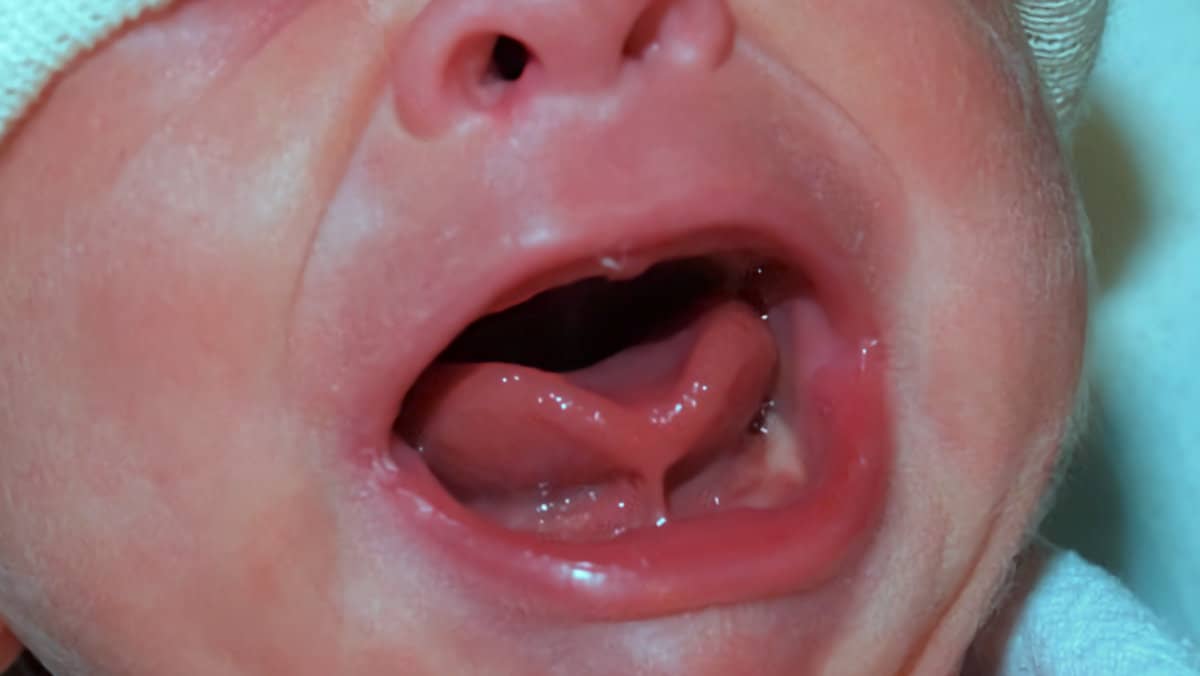 operar frenillo lingual bebés
