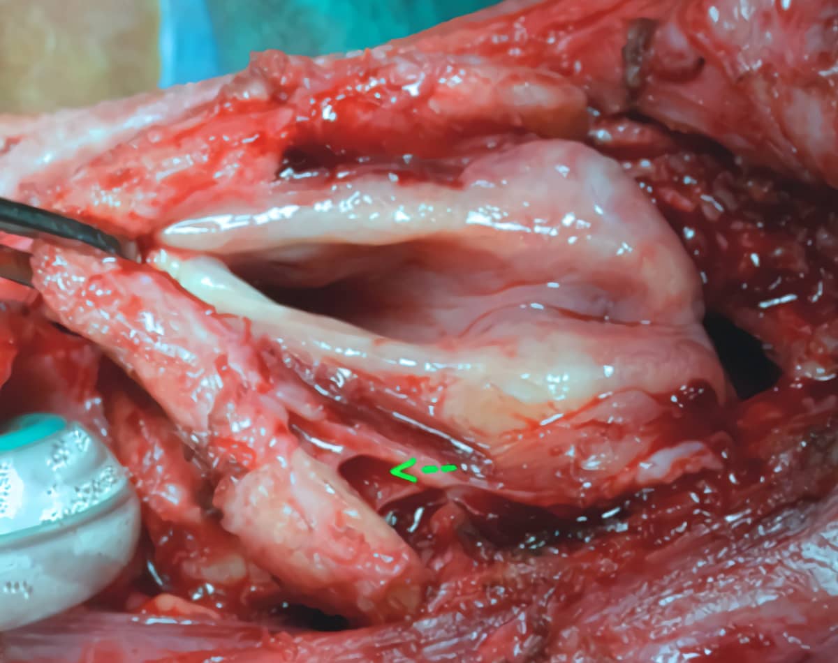 laringectomia operacion